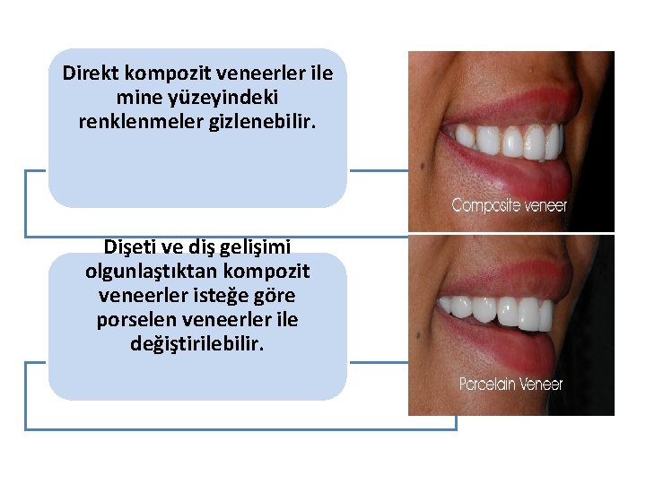 Direkt kompozit veneerler ile mine yüzeyindeki renklenmeler gizlenebilir. Dişeti ve diş gelişimi olgunlaştıktan kompozit