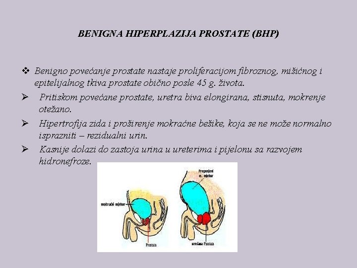 BENIGNA HIPERPLAZIJA PROSTATE (BHP) v Benigno povećanje prostate nastaje proliferacijom fibroznog, mišićnog i epitelijalnog