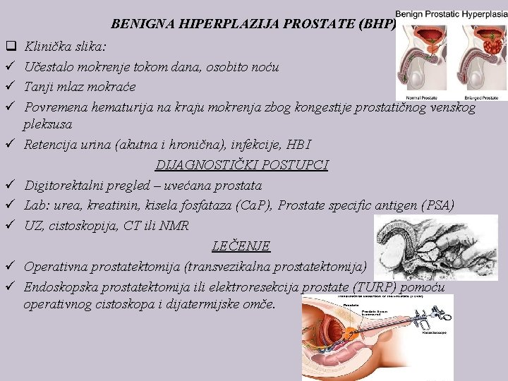 BENIGNA HIPERPLAZIJA PROSTATE (BHP) q ü ü ü ü ü Klinička slika: Učestalo mokrenje