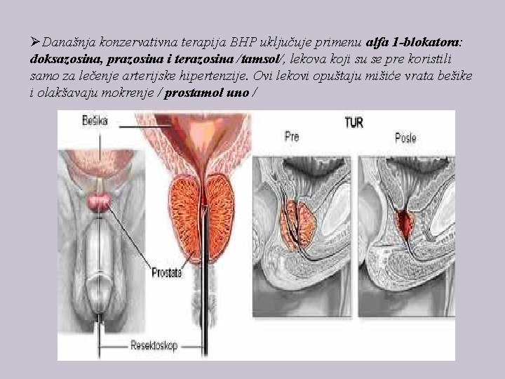 ØDanašnja konzervativna terapija BHP uključuje primenu alfa 1 -blokatora: doksazosina, prazosina i terazosina /tamsol/,