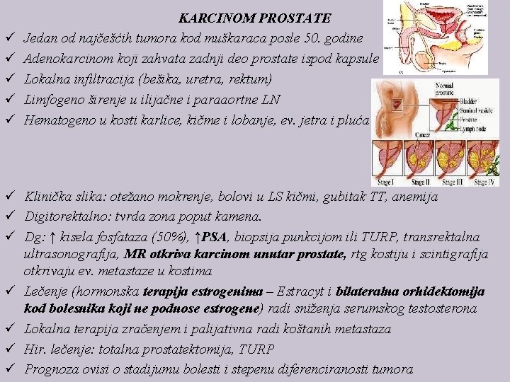 ü ü ü KARCINOM PROSTATE Jedan od najčešćih tumora kod muškaraca posle 50. godine