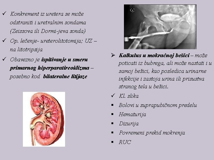 ü Konkrement iz uretera se može odstraniti i uretralnim sondama (Zeissova ili Dormi-jeva sonda)