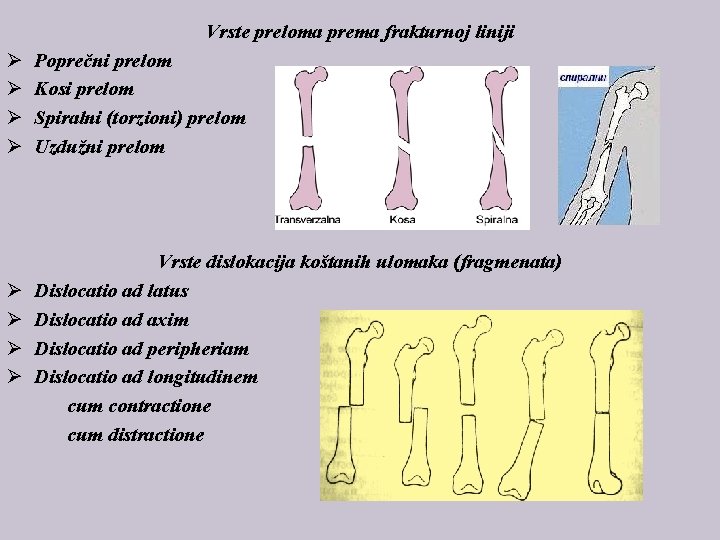 Vrste preloma prema frakturnoj liniji Ø Ø Ø Ø Poprečni prelom Kosi prelom Spiralni