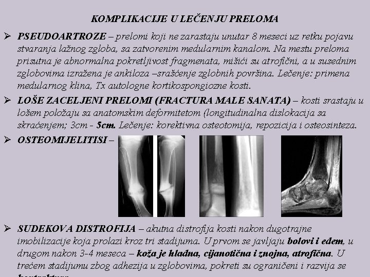 KOMPLIKACIJE U LEČENJU PRELOMA Ø PSEUDOARTROZE – prelomi koji ne zarastaju unutar 8 meseci