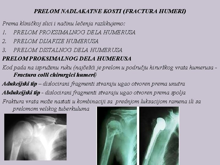 PRELOM NADLAKATNE KOSTI (FRACTURA HUMERI) Prema kliničkoj slici i načinu lečenja razlikujemo: 1. PRELOM