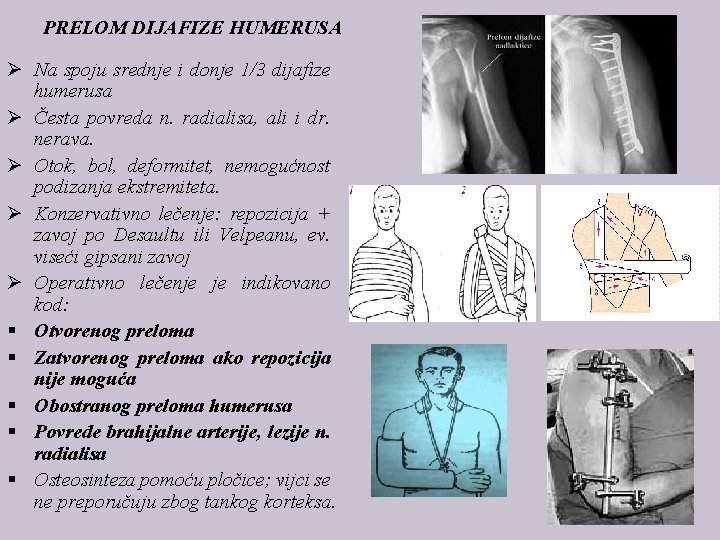 PRELOM DIJAFIZE HUMERUSA Ø Na spoju srednje i donje 1/3 dijafize humerusa Ø Česta