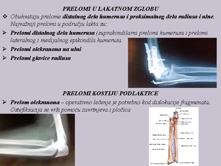v Ø Ø Ø PRELOMI U LAKATNOM ZGLOBU Obuhvataju prelome distalnog dela humerusa i