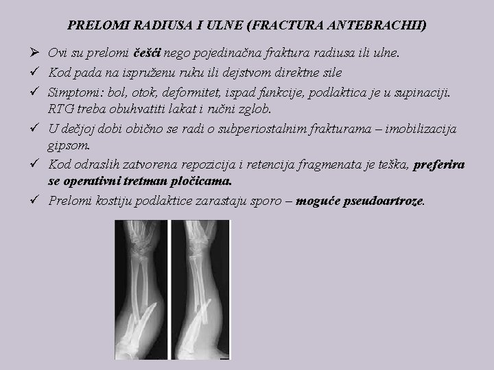 PRELOMI RADIUSA I ULNE (FRACTURA ANTEBRACHII) Ø Ovi su prelomi češći nego pojedinačna fraktura