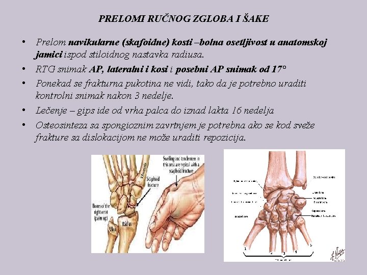 PRELOMI RUČNOG ZGLOBA I ŠAKE • Prelom navikularne (skafoidne) kosti –bolna osetljivost u anatomskoj
