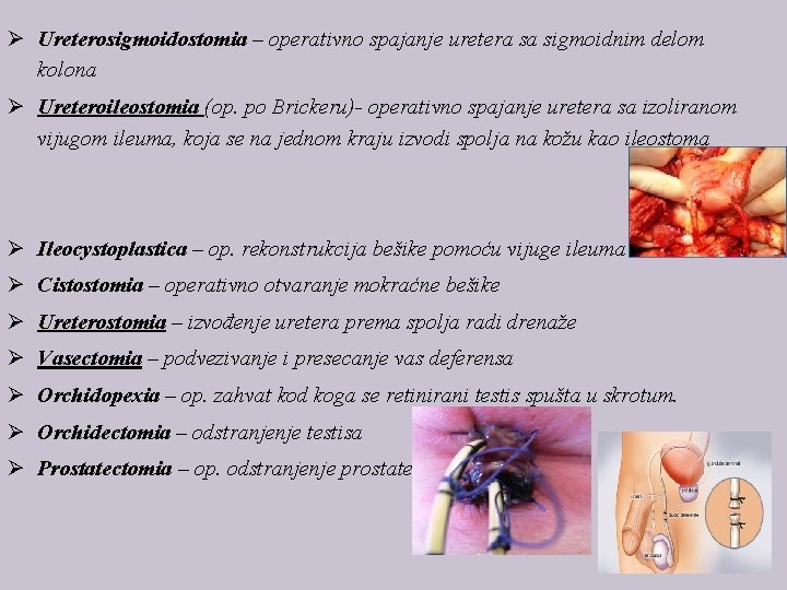 Ø Ureterosigmoidostomia – operativno spajanje uretera sa sigmoidnim delom kolona Ø Ureteroileostomia (op. po