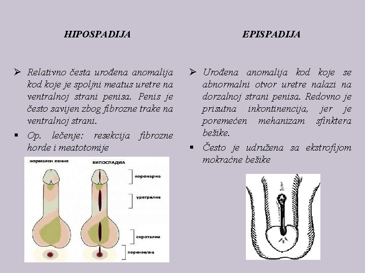 HIPOSPADIJA EPISPADIJA Ø Relativno česta urođena anomalija kod koje je spoljni meatus uretre na