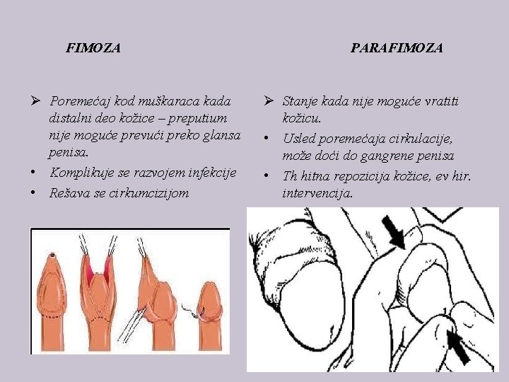 FIMOZA Ø Poremećaj kod muškaraca kada distalni deo kožice – preputium nije moguće prevući