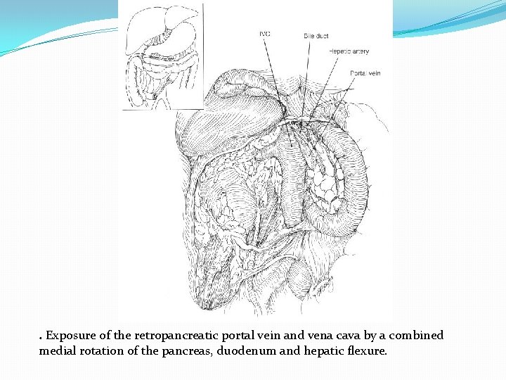 . Exposure of the retropancreatic portal vein and vena cava by a combined medial