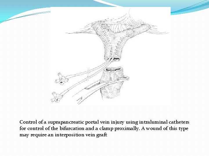 Control of a suprapancreatic portal vein injury using intraluminal catheters for control of the