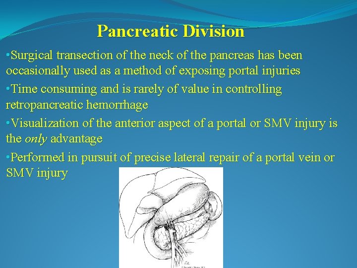 Pancreatic Division • Surgical transection of the neck of the pancreas has been occasionally
