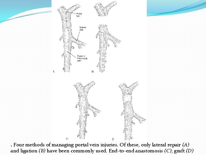 . Four methods of managing portal vein injuries. Of these, only lateral repair (A)