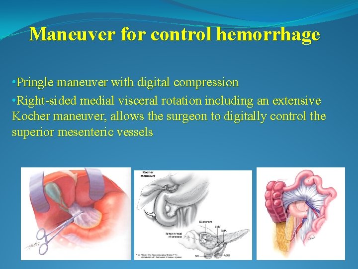 Maneuver for control hemorrhage • Pringle maneuver with digital compression • Right-sided medial visceral
