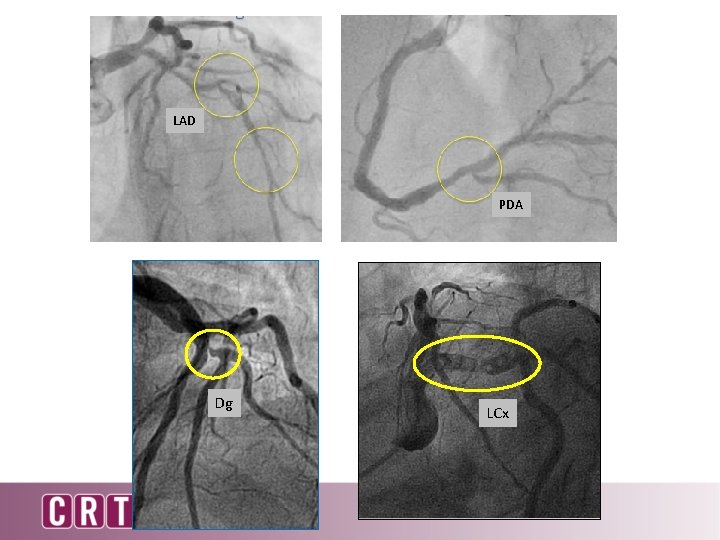 LAD PDA Dg LCx 