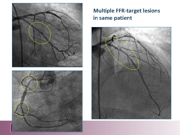 Multiple FFR-target lesions in same patient 