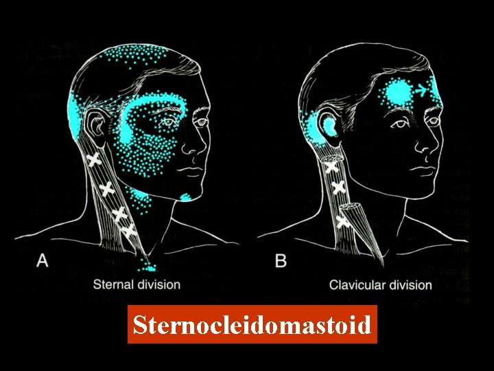 Sternocleidomastoid 