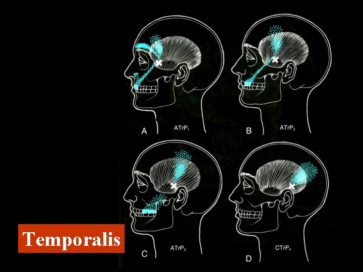 Temporalis 