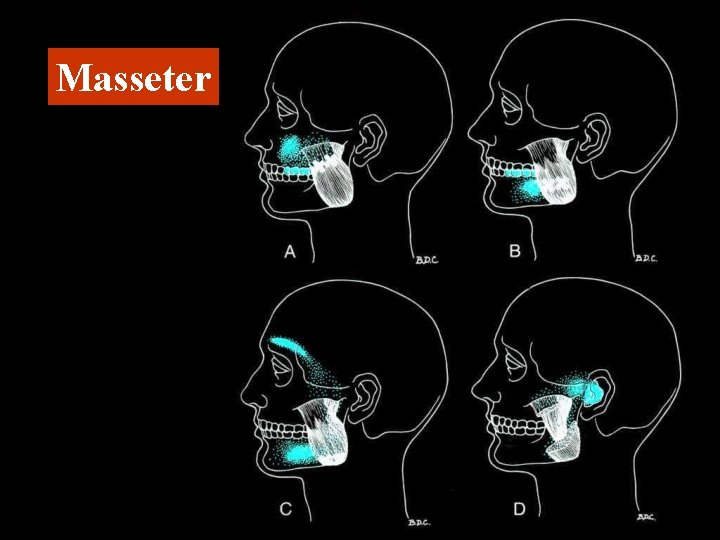 Masseter 