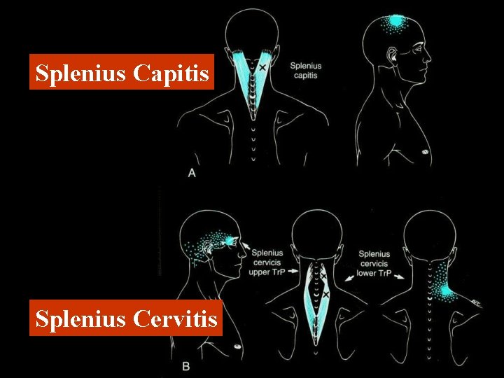 Splenius Capitis Splenius Cervitis 