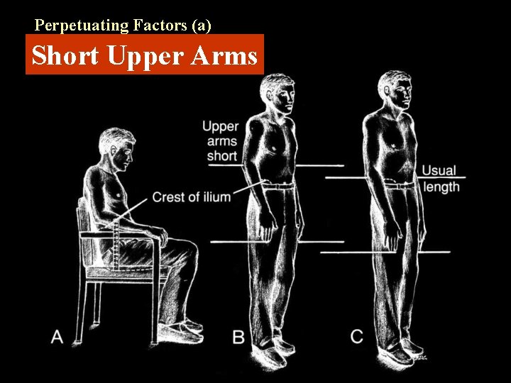 Perpetuating Factors (a) Short Upper Arms 