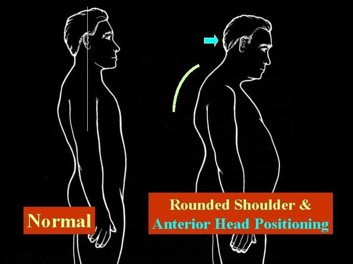 Normal Rounded Shoulder & Anterior Head Positioning 