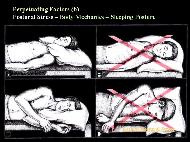 Perpetuating Factors (b) Postural Stress – Body Mechanics – Sleeping Posture Back to Postural