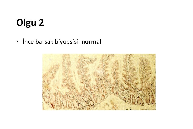 Olgu 2 • İnce barsak biyopsisi: normal 