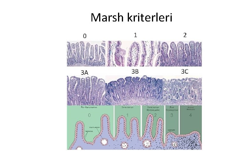 Marsh kriterleri 
