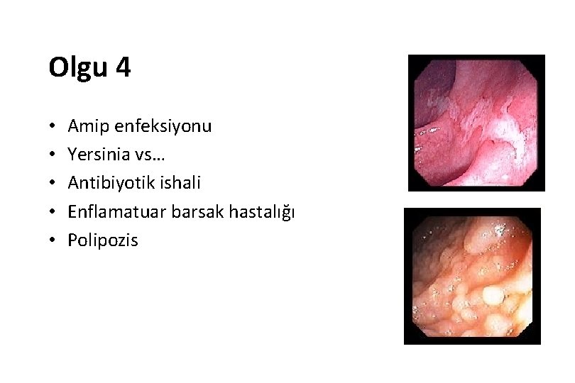 Olgu 4 • • • Amip enfeksiyonu Yersinia vs… Antibiyotik ishali Enflamatuar barsak hastalığı