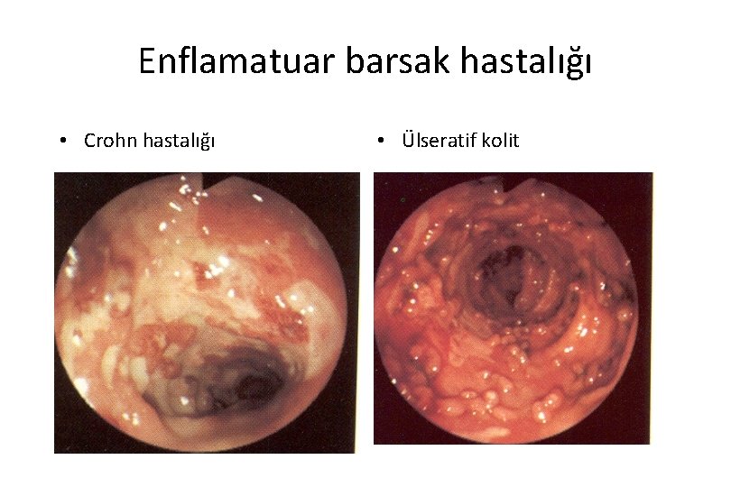 Enflamatuar barsak hastalığı • Crohn hastalığı • Ülseratif kolit 