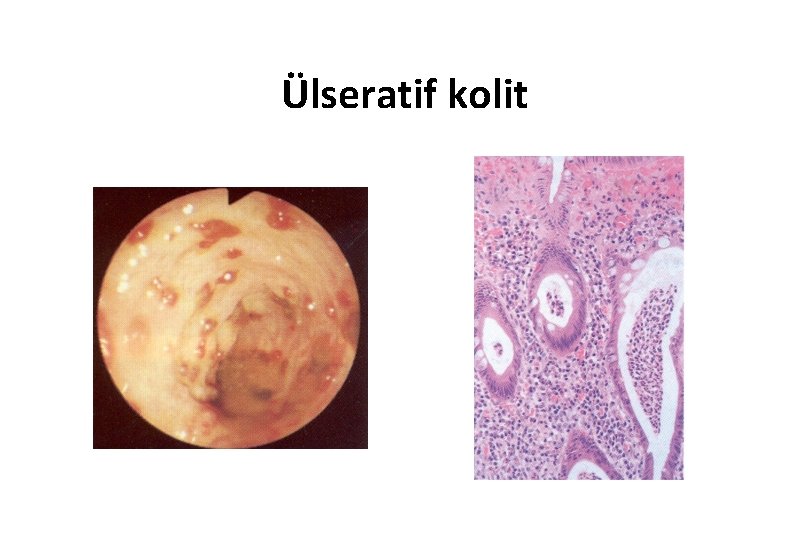 Ülseratif kolit 