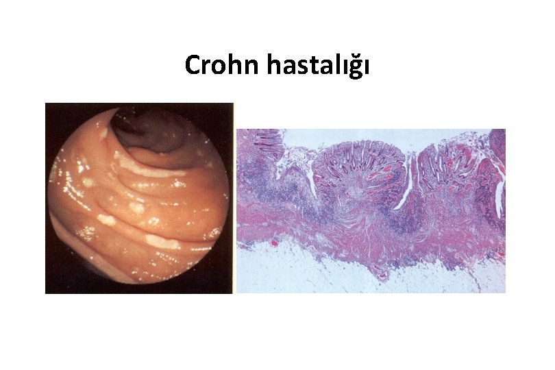 Crohn hastalığı 