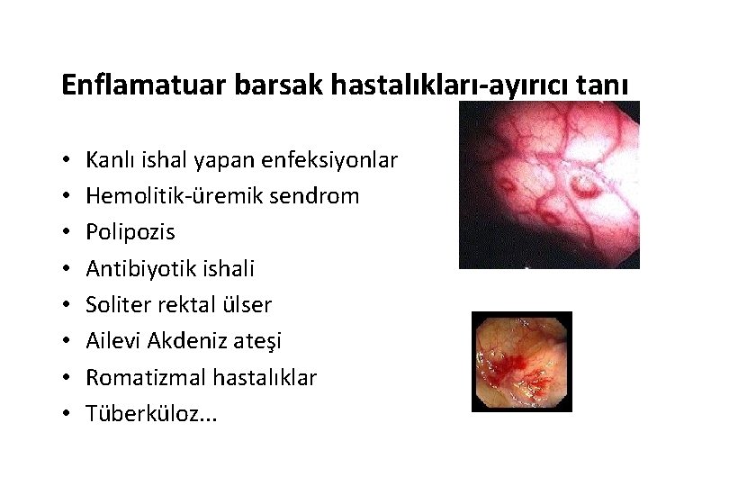 Enflamatuar barsak hastalıkları-ayırıcı tanı • • Kanlı ishal yapan enfeksiyonlar Hemolitik-üremik sendrom Polipozis Antibiyotik