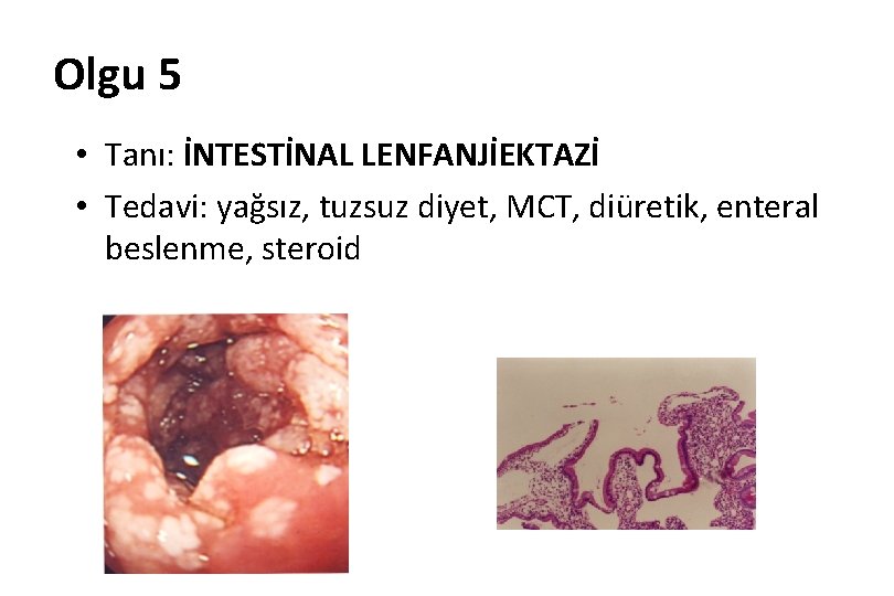Olgu 5 • Tanı: İNTESTİNAL LENFANJİEKTAZİ • Tedavi: yağsız, tuzsuz diyet, MCT, diüretik, enteral