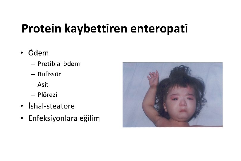 Protein kaybettiren enteropati • Ödem – – Pretibial ödem Bufissür Asit Plörezi • İshal-steatore