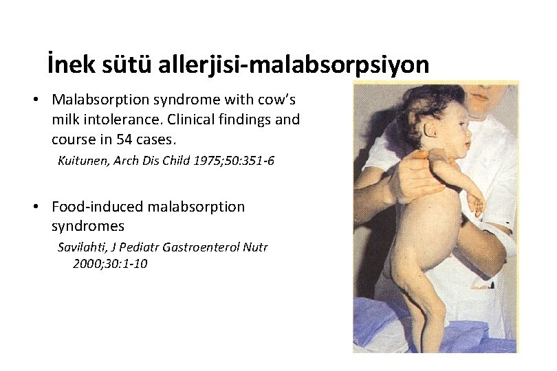 İnek sütü allerjisi-malabsorpsiyon • Malabsorption syndrome with cow’s milk intolerance. Clinical findings and course