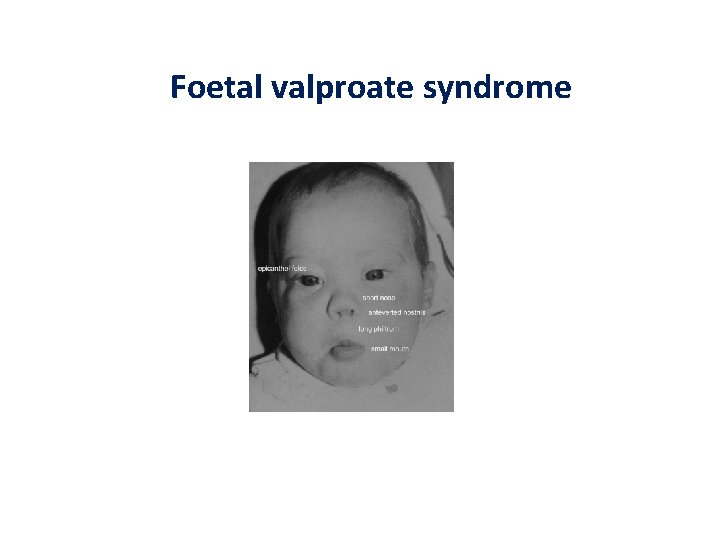 Foetal valproate syndrome 