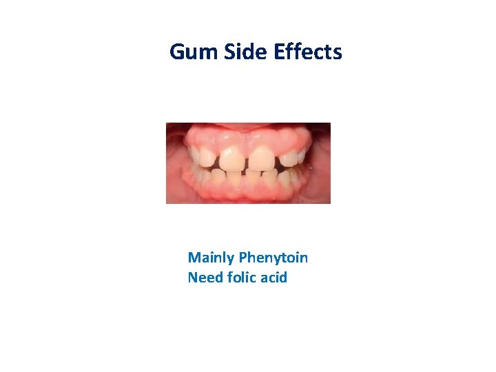 Gum Side Effects Mainly Phenytoin Need folic acid 