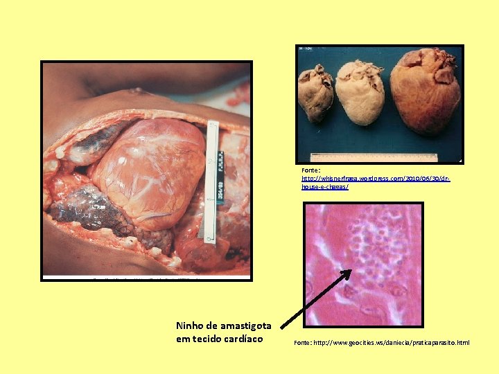 Fonte: http: //whisnerfraga. wordpress. com/2010/06/30/drhouse-e-chagas/ Ninho de amastigota em tecido cardíaco Fonte: http: //www.