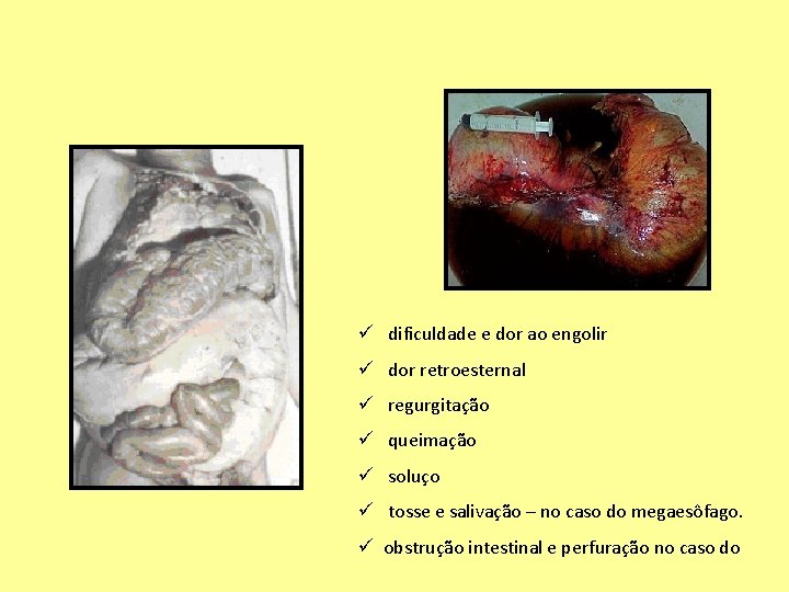 ü dificuldade e dor ao engolir ü dor retroesternal ü regurgitação ü queimação ü