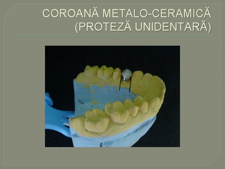 COROANĂ METALO CERAMICĂ (PROTEZĂ UNIDENTARĂ) COROANĂ METALO CERAMICĂ (PROTEZĂ UNIDENTARĂ)