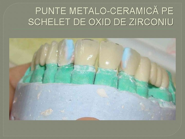 PUNTE METALO CERAMICĂ PE SCHELET DE OXID DE ZIRCONIU PUNTE METALO CERAMICĂ PE SCHELET DE OXID DE ZIRCONIU