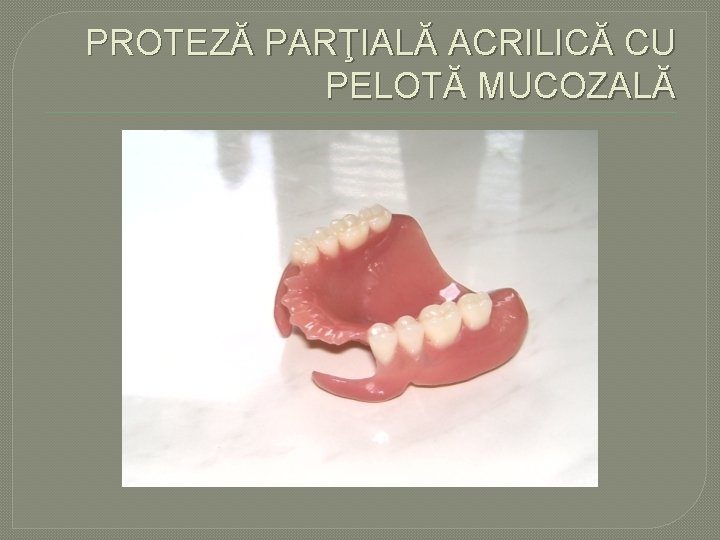 PROTEZĂ PARŢIALĂ ACRILICĂ CU PELOTĂ MUCOZALĂ PROTEZĂ PARŢIALĂ ACRILICĂ CU PELOTĂ MUCOZALĂ