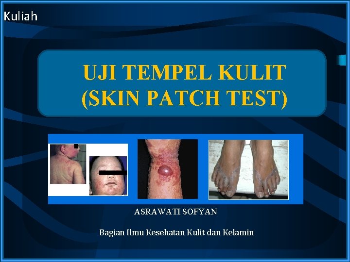 Kuliah UJI TEMPEL KULIT (SKIN PATCH TEST) ASRAWATI SOFYAN Bagian Ilmu Kesehatan Kulit dan