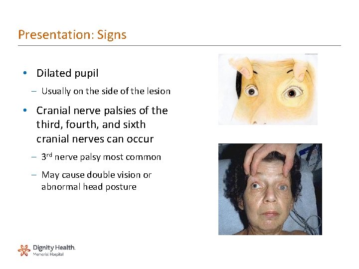 Presentation: Signs • Dilated pupil – Usually on the side of the lesion •