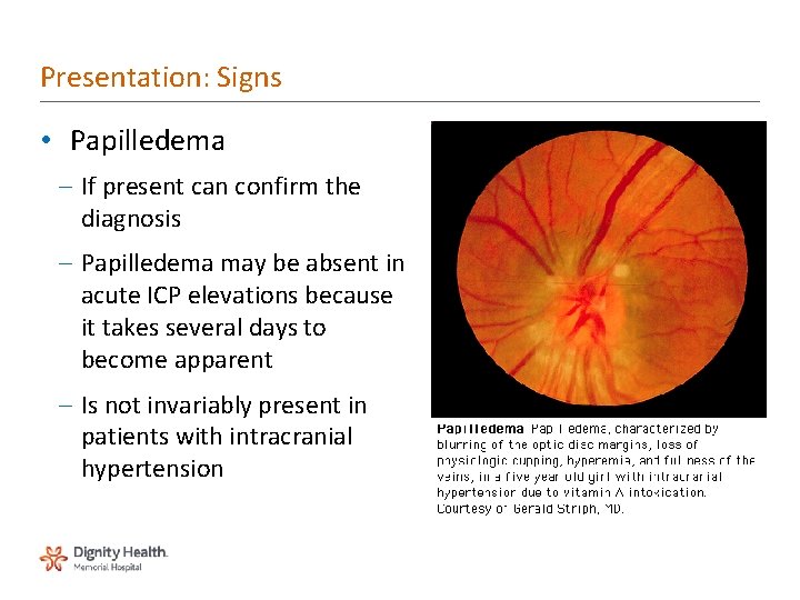 Presentation: Signs • Papilledema – If present can confirm the diagnosis – Papilledema may